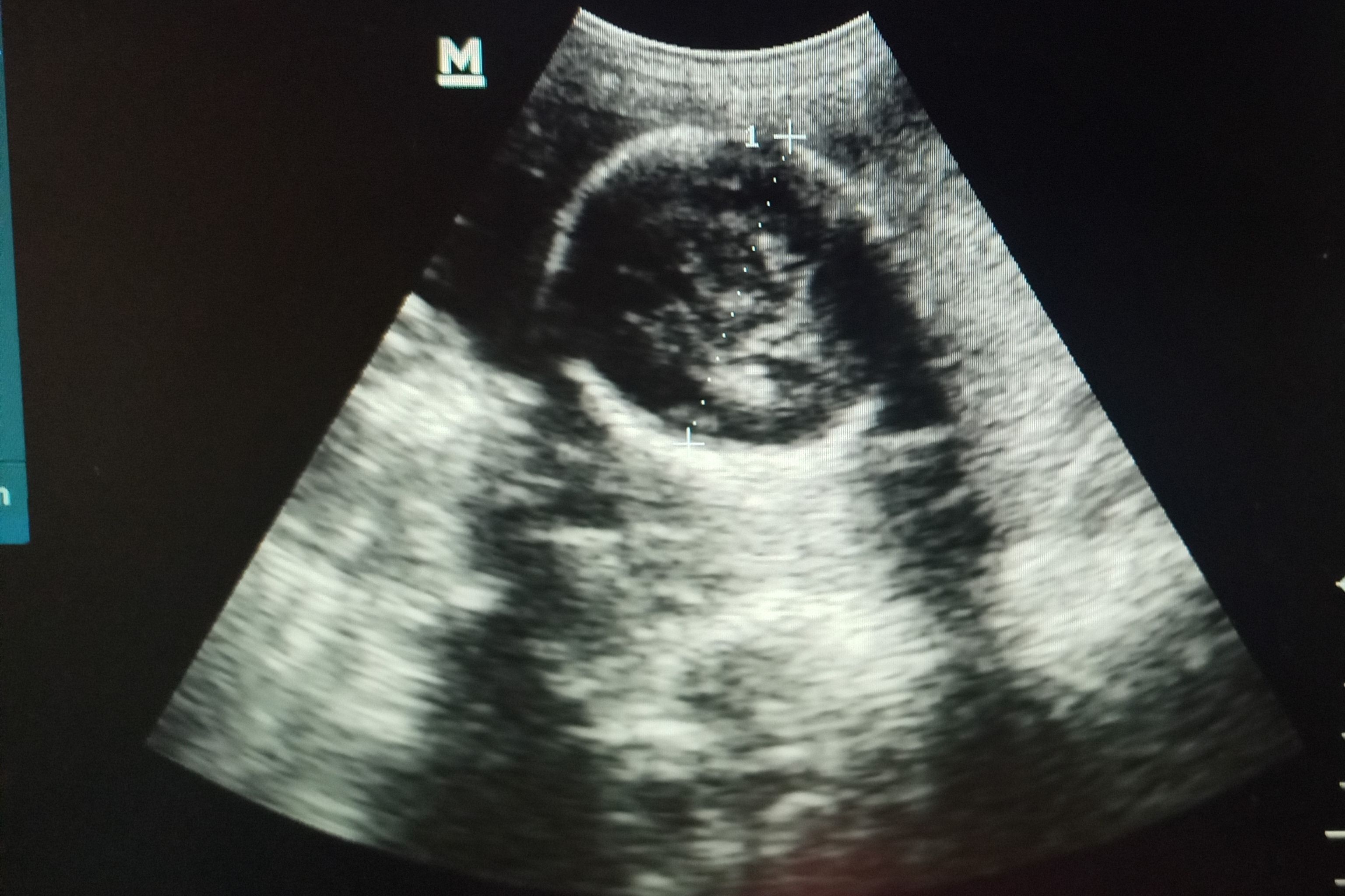Pregnancy,Ultrasonography,(usg),In,The,Late,Trimester