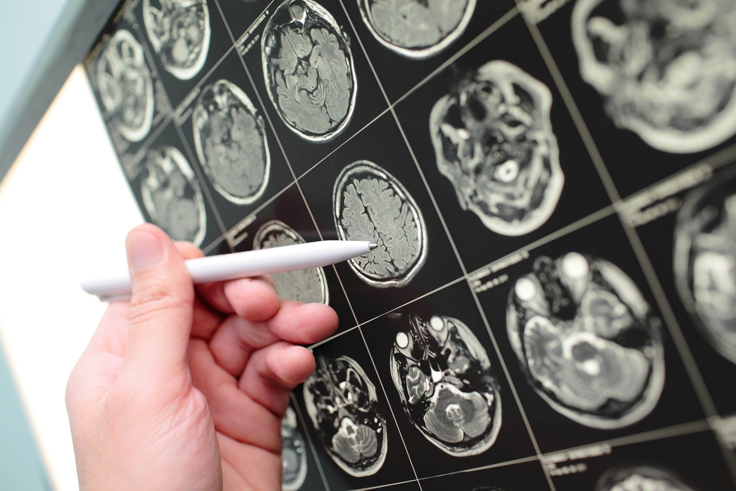Doctor,Denoting,With,Pen,On,The,Mri,Test,Result.