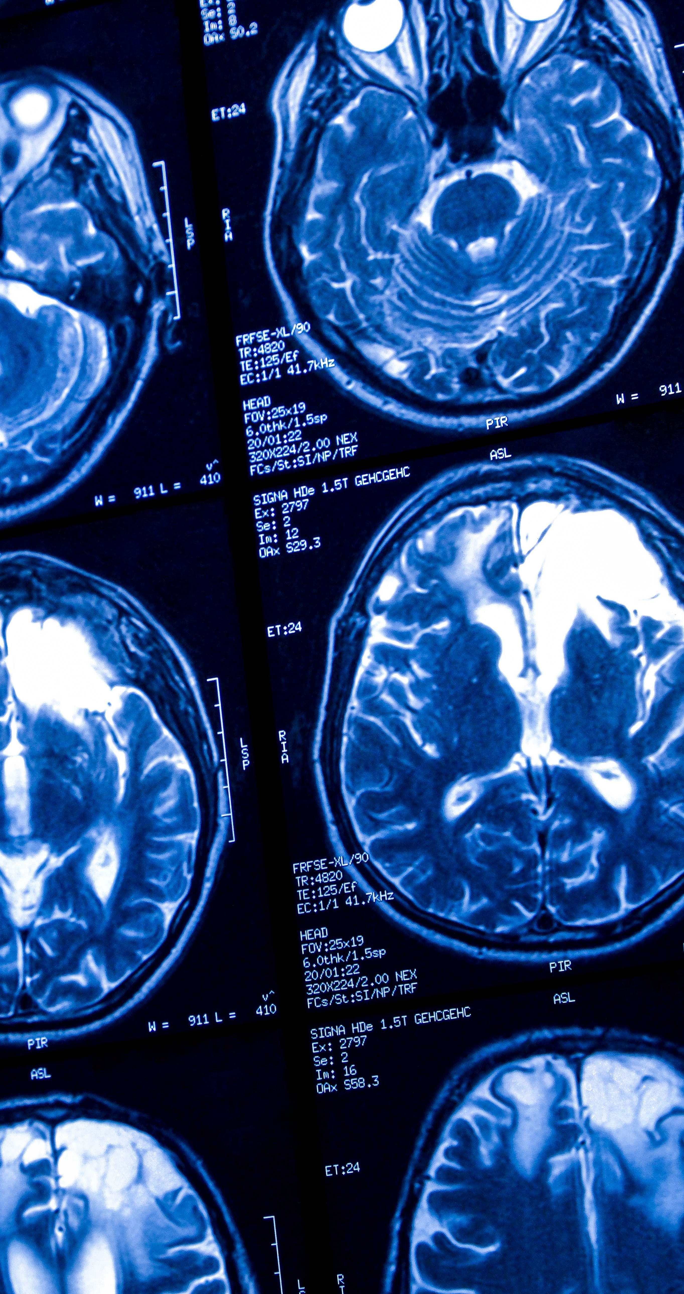 Naukowcy odkryli, co sprawia, że mózg starzeje się szybciej